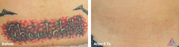 Before and after tattoo removal